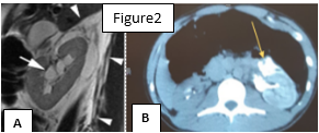 Figure 2: Renal computed tomography image. 2A: Ureterohydronephrosis with urinoma. 2B: Contrast medium extravasation related to fornix’s rupture.