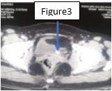 Figure 3: Computed Tomography image Of distal lithiasis of the left ureter (lithiasis of the ureterovesical junction).