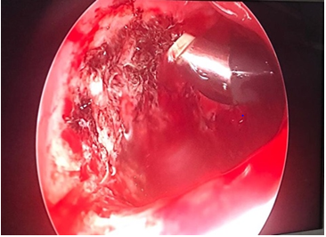 Figure 2: Microdebrider Wand in Nasopharynx with Grade 3 Adenoids.