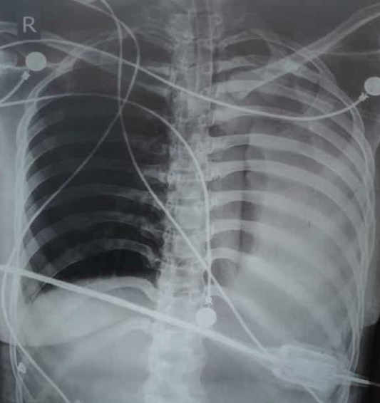 Figure 1: Chest X-Ray showing pneumothorax and pleural effusion.