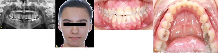 Figure 1: a) Panoramic radiograph view. OKC located in the anterior mandible; b) Preoperative clinical aspect of the patient’s face; c) Preoperative clinical intraoral view; d) Clinical occlusal view of the anterior mandible.