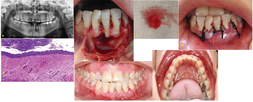 Figure 2: a) View of the panoramic radiograph after endodontic treatment; b) Clinical view at the time of surgery phase; c) Photograph showing macroscopic aspects of the lesion; d) Immediate postoperative view following surgery; e) Histopathological view of the lesion. (×100 magnification, HE staining); f and g) Postoperative clinical and occlusal view four weeks after surgery.