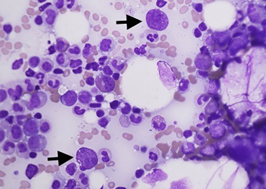 Figure 1: (Courtesy of BMJ LN – 5513871279207) Bone Marrow Aspirate Showing Parvo B19 Infecting Erythroid Precursors.
