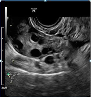 Figure 1: Transvaginal ultrasonography at an emergent visit. A) A right ovary showed a typical PCO finding. B) A solid mass measuring at 72.8 x 42.8 mm was detected in the Douglas’ pouch. Edema was prominent, and no typical PCO findings were observed.