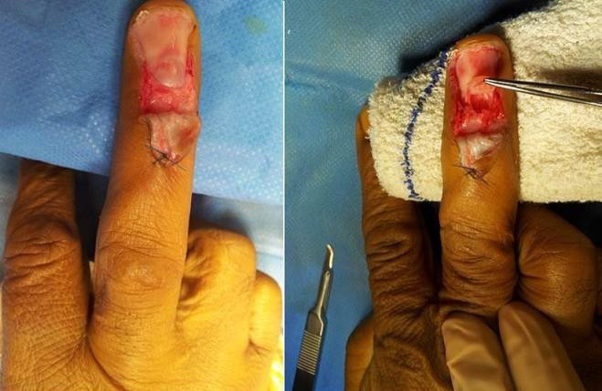 Figure 2: Transungual surgical approach.
