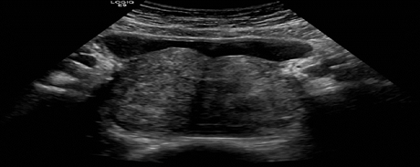 Figure 1: Ultrasound of Prostate (Transverse View).