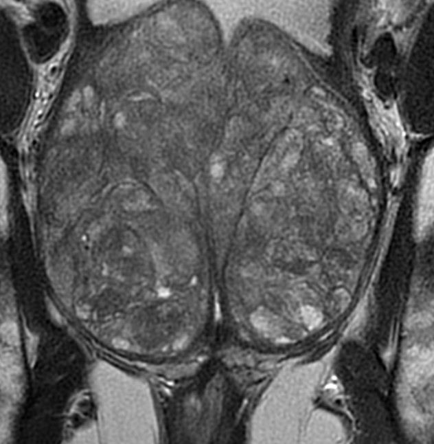 Figure 4: Coronal view of the prostate MRI.