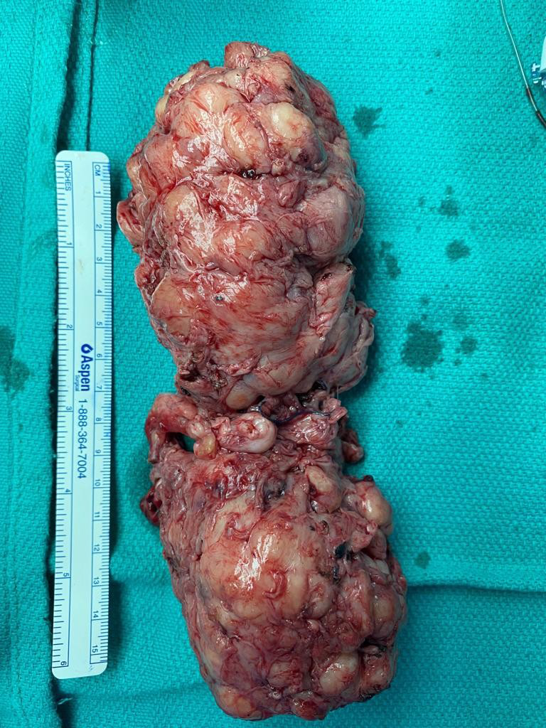 Figure 5: Prostate of the patient after removal.