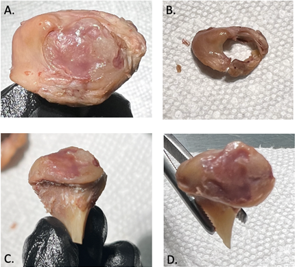 Figure 2: Demonstrates the disease severity of the mandibular condyle, fossa and articular disc on the 88-years-old male donor. (A) Image represents the residual articular disc, represented by a ring of fibrocartilaginous tissue surrounding the circumference of the mandibular condyle. (B) Image represents the articular disc dissected away from the condyle. (C) Image represents an anterior view of the condyle. (D) Image represents a superior view of the substantial cartilage erosions on the condyle.