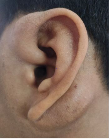 Figure 2: Swelling Behind Left Ear.