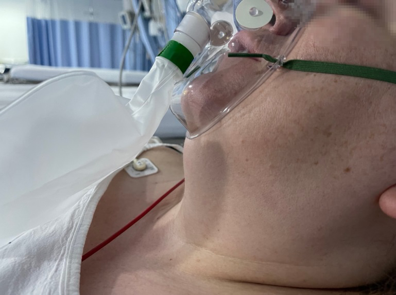 Figure 3: Lidocaine micronebulization on patient.
