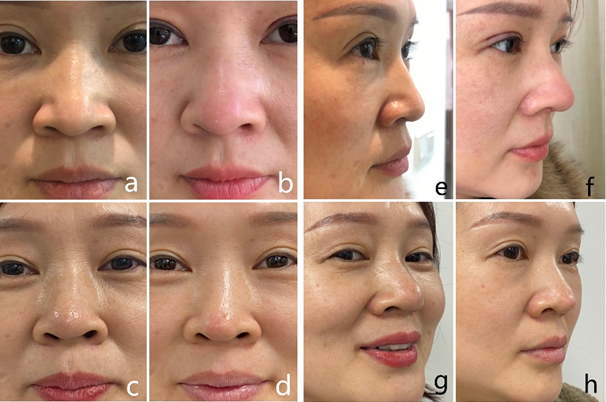 Figure 1: A 35-year-old woman who underwent nasal tip plasty with medpor prosthesis and ear cartilage, facial front and side appearance. (a,e) Preoperative view. (b,f) 6 months post-operation, patient is satisfied with the shape. (c,g) 1 year post- operation, narrow and small nasal tip, no expression points, and the appearance of the prosthesis were found. (d,h) 1 year after combined PRP plasty of nasal tip with medpor prosthesis and ear cartilage.
