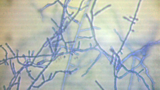 Figure 5: _M. audouinii_ Showed pectinate hyphae. Microconidia (red arrow) and macroconidia cells (black arrows). Antifungal sensitivity test with disc method showed high sensitivity to Terbinafine Itraconazole and Voriconazole while moderate sensitivity to Fluconazole and Miconazole. The patient was treated with oral Terbinafine as dose of 250 mg/day for 8 weeks which showed marked improvement from fourth week.
