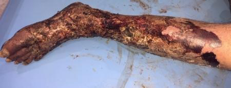 Figure 1: Necrotic plaques on the left leg and foot with bilateral edema.