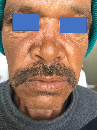 Figure 2: Lorgnette nose.