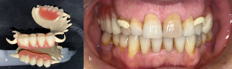 Figure 9: a. Finished and polished PEEK RPD; b. Insertion of PEEK RPD.
