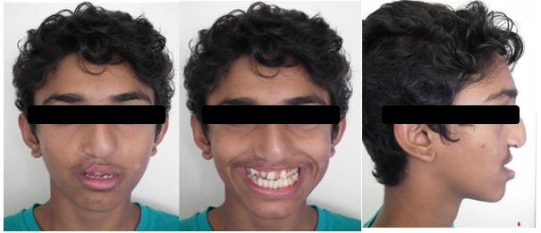 Figure 1: Pretreatment extraoral photographs.