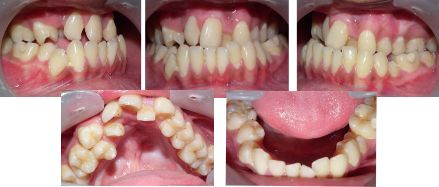 Figure 2: Pretreatment intra oral photographs.