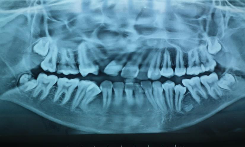 Figure 3: Pretreatment radiographs.