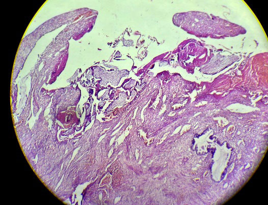 Figure 3: Any compromise in the capacity of the uterine cavity.