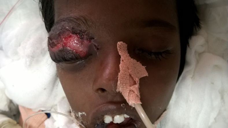 Figure 1: Periorbital edema and necrosis with normal reacting pupil.