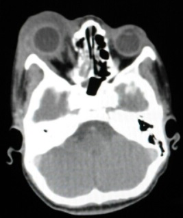 Figure 2: CT of inferolateral displacement of the eyeball.