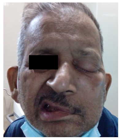 Figure 1: Patient with HB grade 6 Bell’s palsy. A 66 year old male presented with sudden onset of deviation of mouth and drooping of Left upper eyelid since 1 day.