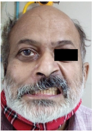 Figure 2: Patient with HB Grade 5 palsy. A 59 year old male presented with sudden onset of deviation of mouth since 5 hours of presentation.