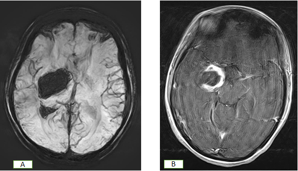 Figure 2: SWI (A) shows right temporal lobe bleed which on post contrast (T1C) shows rim enhancement suggesting lesion.