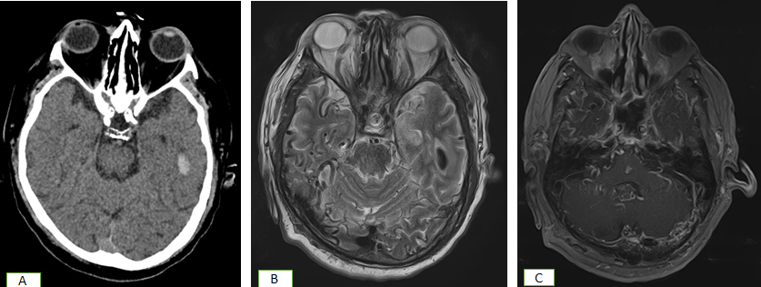 Figure 3: CT scan (A) shows bleed in the left temporal lobe. Subsequent T2w (B) and T1W(C) show same findings with associated CVST and numerous vascular channels.