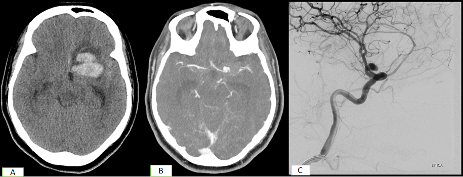Figure 4: CT Scan (A) shows bleed in the left frontal lobe. Subsequent CTA (B) and DSA (C) show left supraclinoid ICA aneurysm.