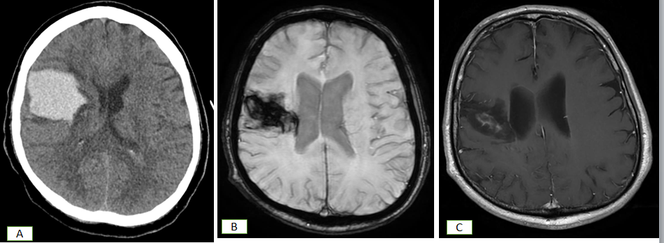 Figure 7: CT Scan (A) shows bleed at right frontal lobe .Subsequent SWI (B) shows blood and T1wC MRI ( C)shows significant resolution.