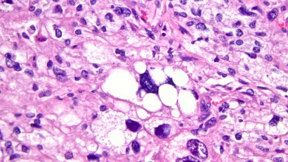 Figure 1: Pleomorphic liposarcoma demonstrating variable quantities of pleomorphic lipoblasts admixed with high grade, undifferentiated, pleomorphic sarcoma composed of spindle shaped cells with hyperchromatic nuclei. Foci of necrosis and prominent mitotic activity are seen [6].