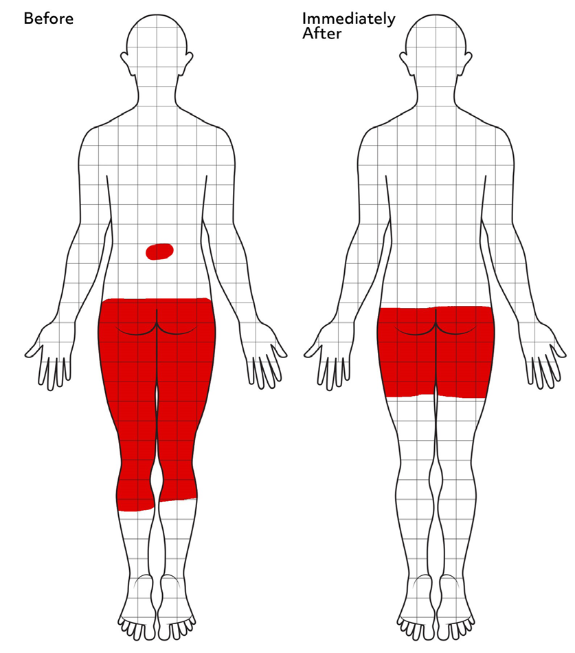 Figure 1: Example of body pain drawings with grid measure in patients with spinal pain before and immediately following DN.