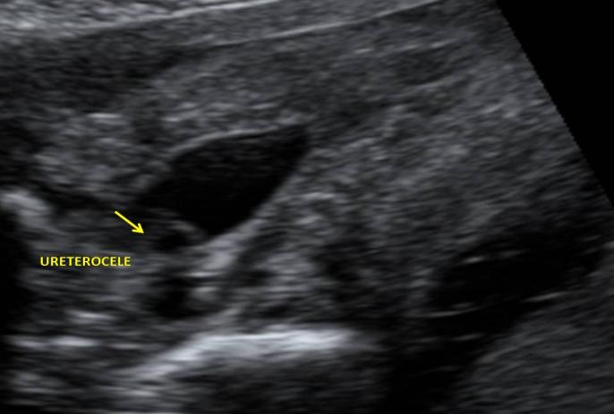 Figure 2: Ureterocele on distal right ureter intravesicale part.