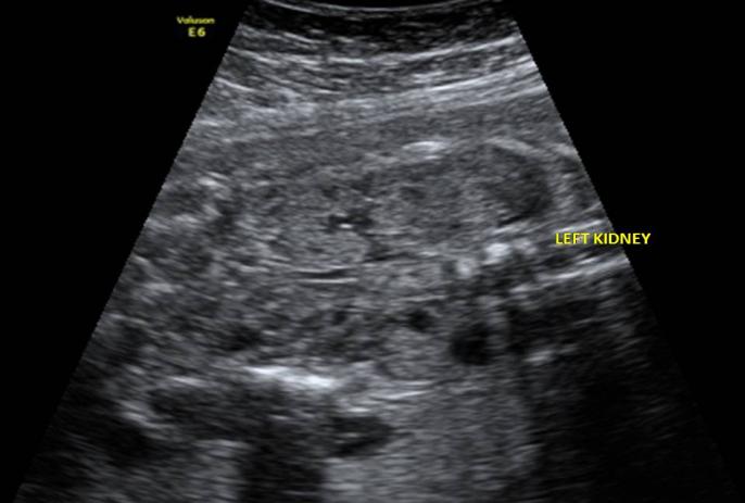 Figure 3: Increased size and double renal pelvis on left kidney.