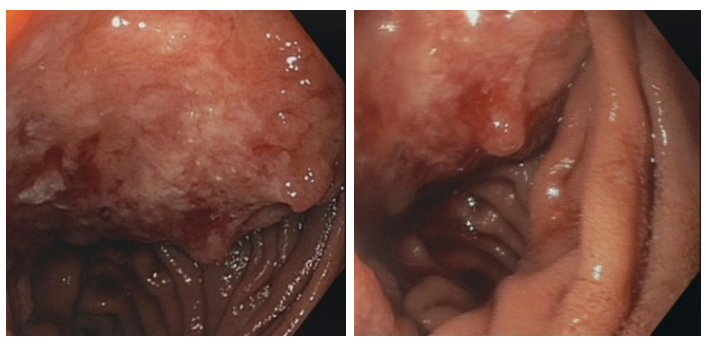 Figure 2: View of the tumor invasion in the duodenum by endoscopy.