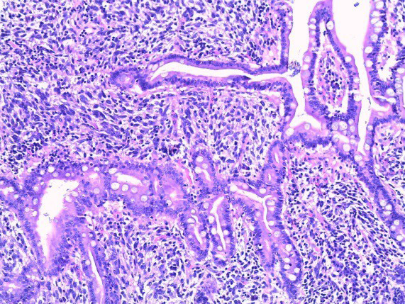 Figure 3: Tumor cells infiltration inside duodenal mucosa (10x10 hematoxylin-eosin staining).