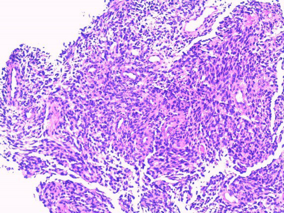Figure 4: Tumor cells infiltration inside duodenal mucosa (10x10 hematoxylin-eosin staining).