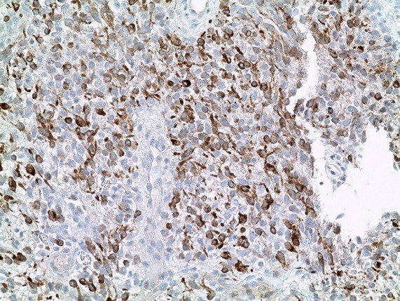 Figure 5: Expressing melanoma markers Melan-A (20x10 Melan-A staining).