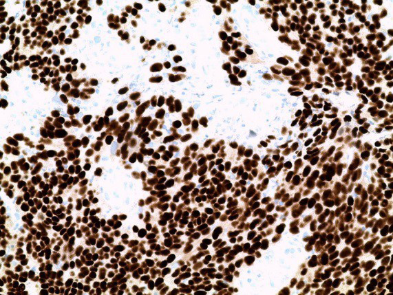 Figure 6: Expressing melanoma markers SOX10 (20x10 “SOX10” staining).