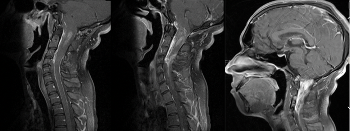 Figure 2: Preoperative sagittal and axial MRI with contrast of the cervical spine; significant for enhancing mass from C1-C7 measuring 60 mm craniocaudal span (Second patient).