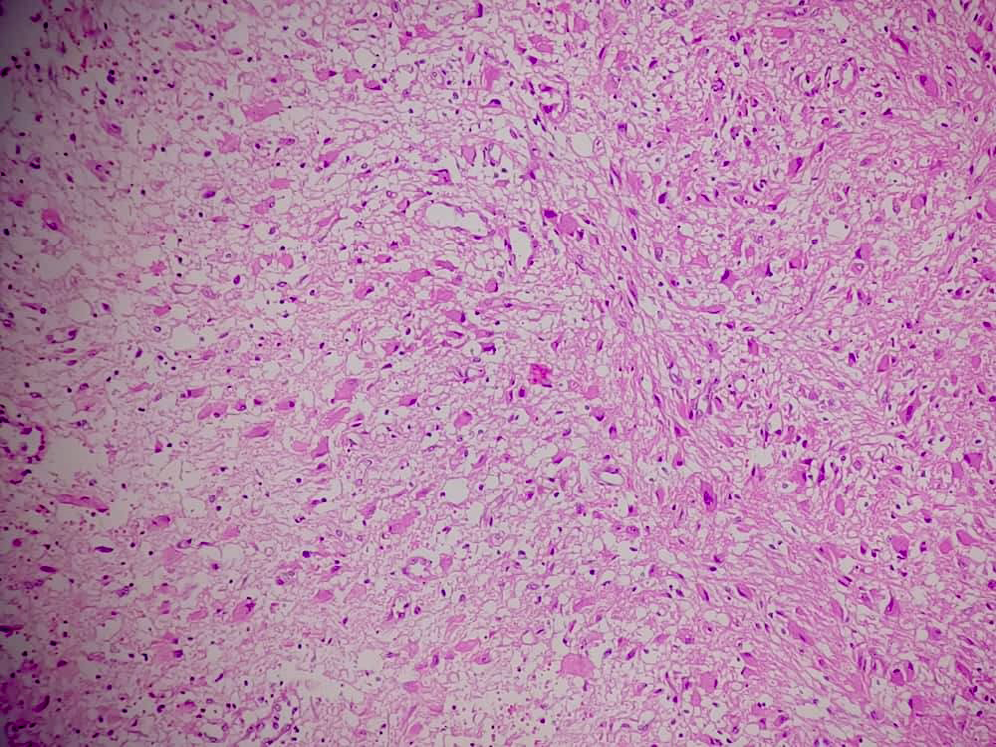 Figure 4: Negative immunohistochemical staining for isocitrate dehydrogenase-1 (200×).