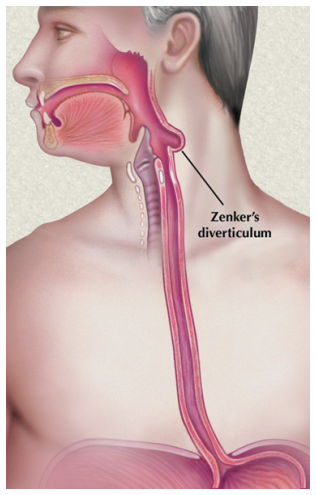 Figure 2: The septum separates the _Zenker diverticulum_ from the true esophageal lumen.