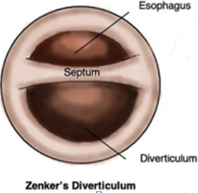 Figure 3: A schematic of the cricopharyngeal myotomy.
