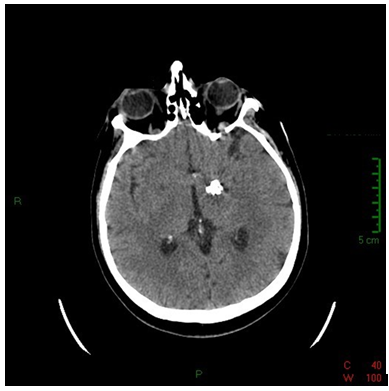 Figure 1: Computed axial tomography cross section without evidence of damage.