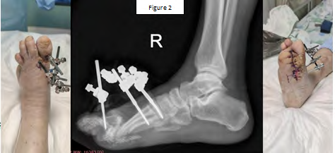 Figure 2: The Sore was closed after 2.5 months of treatment, offloading, non-weight bearing, Following physiotherapy, he started walking.