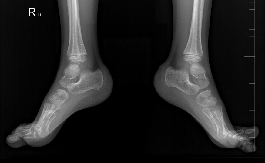Figure 2: Last X-Ray lateral view.