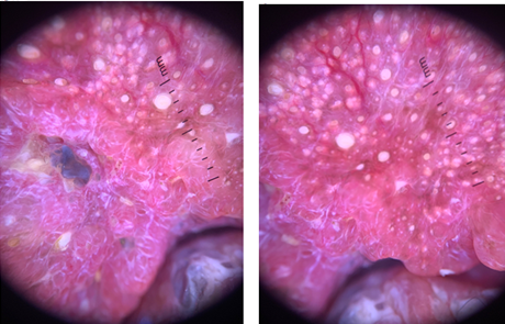 Figure 2: Dermatoscopy show dilated and sebum-filled follicular openings, keratinized coneson an erythematous background, yellowish crusts, and scattered polygonal and branching vessels.