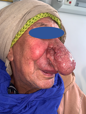 Figure 3: Good evolution with disappearance of the signs of cutaneous infection.